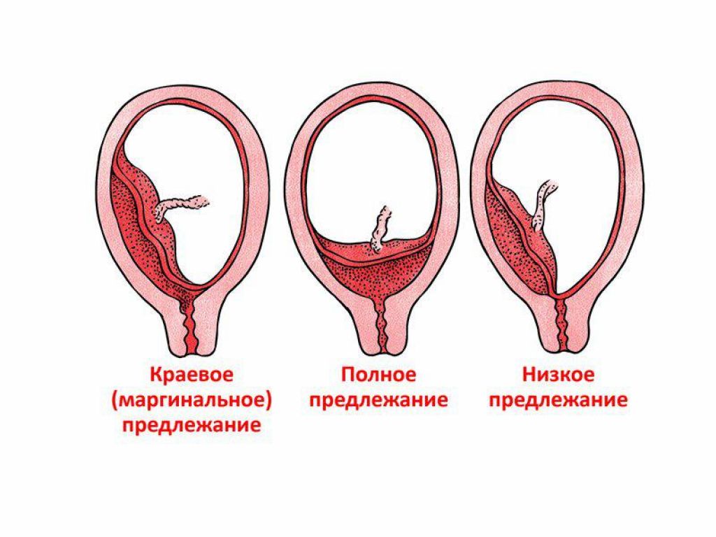 Презентация отслойка плаценты